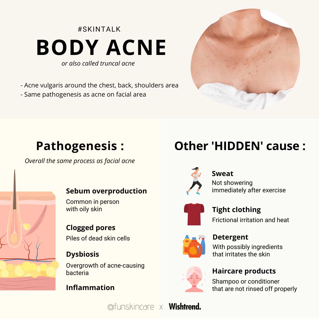 Skincare Tips For Body Acne: From Cleansing To Non-Skincare Tips – Wishtrend